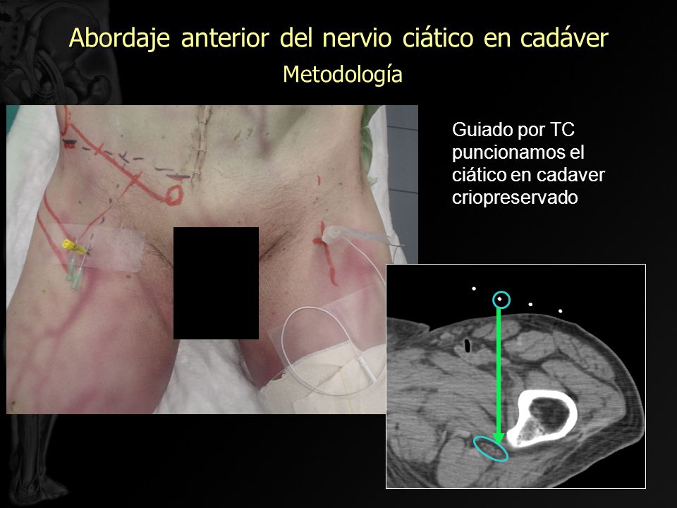 Abordaje anterior del nervio ciático en cadáver Metodología