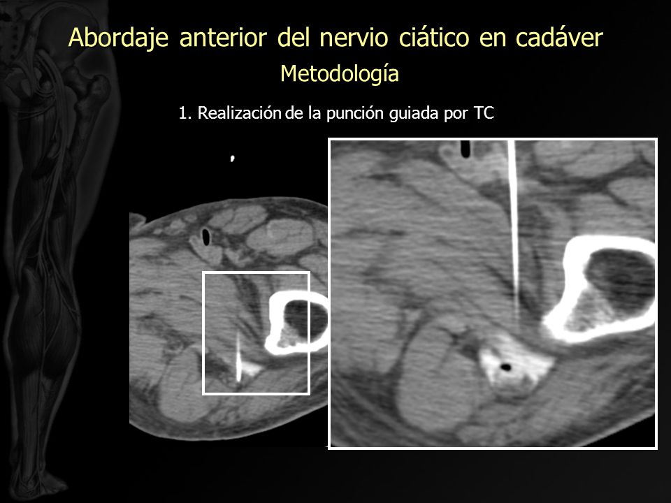 Abordaje anterior del nervio ciático en cadáver Metodología