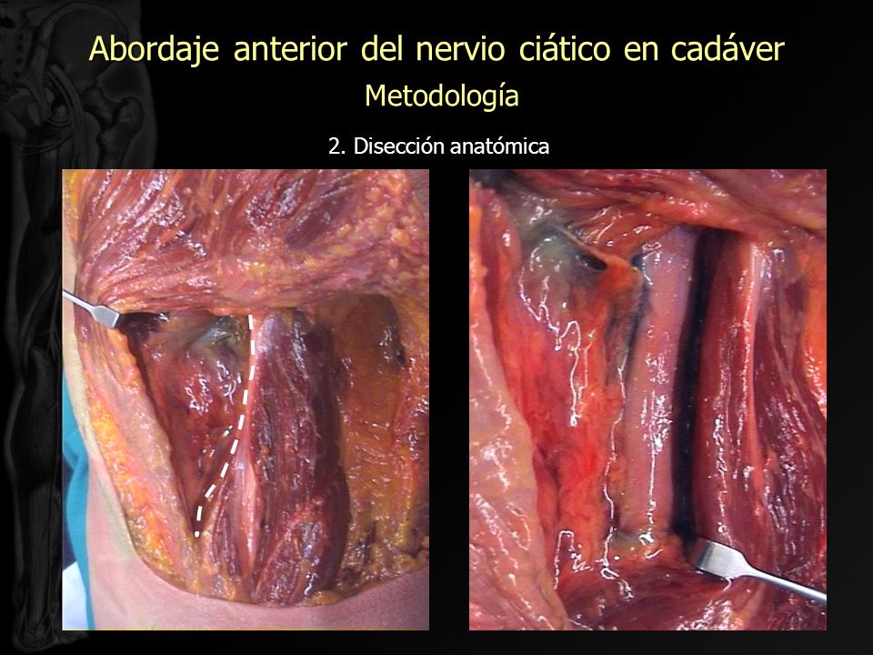 Abordaje anterior del nervio ciático en cadáver Metodología