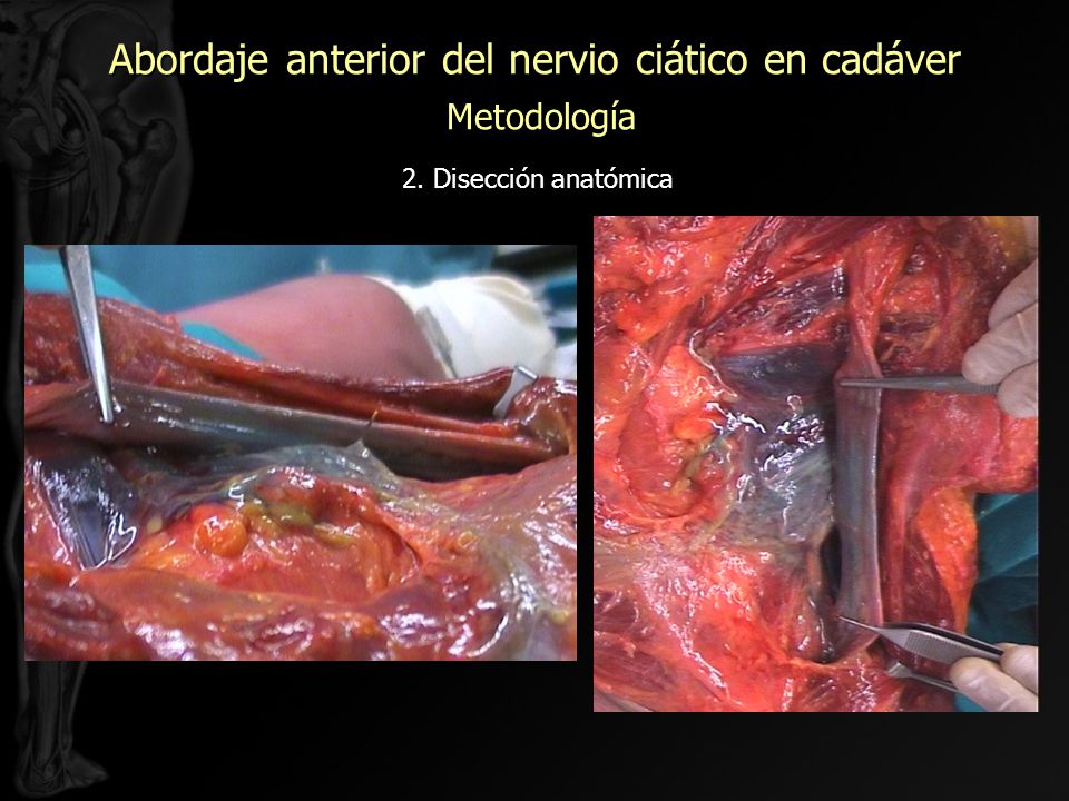 Abordaje anterior del nervio ciático en cadáver Metodología