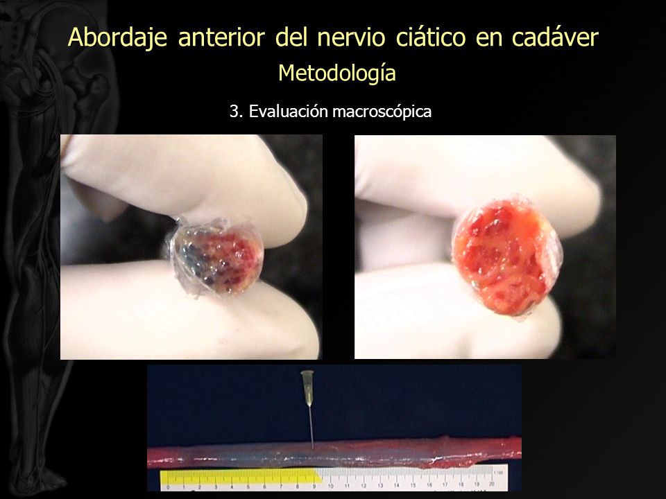 Abordaje anterior del nervio ciático en cadáver Metodología