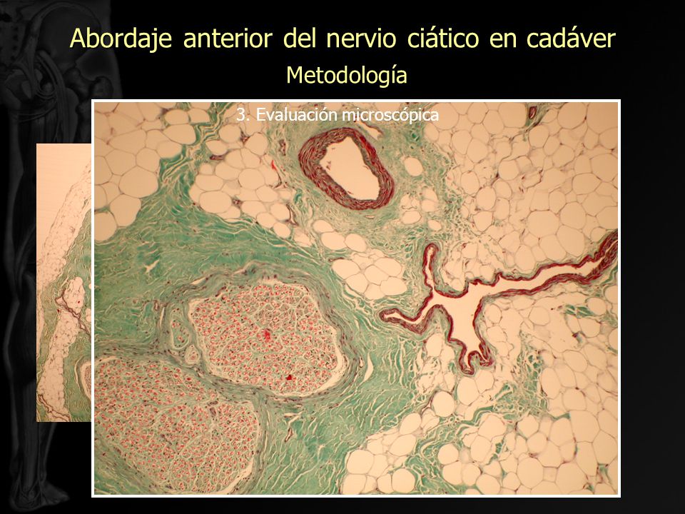 Abordaje anterior del nervio ciático en cadáver Metodología