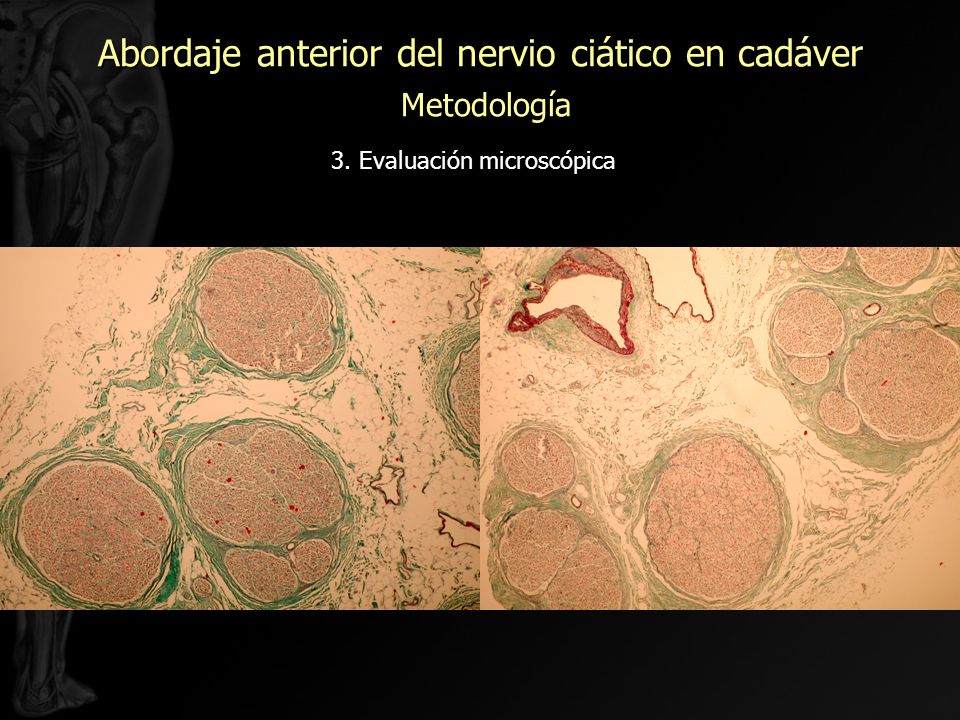 Abordaje anterior del nervio ciático en cadáver Metodología