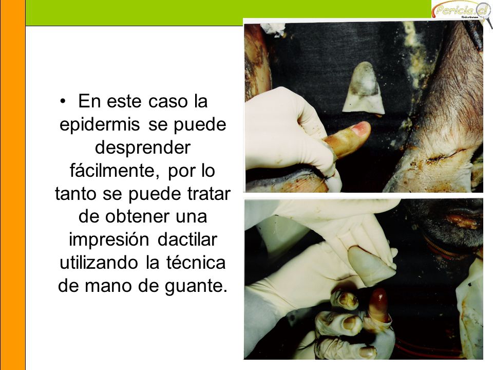 En este caso la epidermis se puede desprender fácilmente, por lo tanto se puede tratar de obtener una impresión dactilar utilizando la técnica de mano de guante.