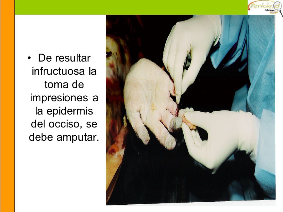 De resultar infructuosa la toma de impresiones a la epidermis del occiso, se debe amputar.