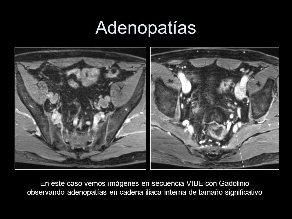 Adenopatías En este caso vemos imágenes en secuencia VIBE con Gadolinio observando adenopatías en cadena iliaca interna de tamaño significativo.