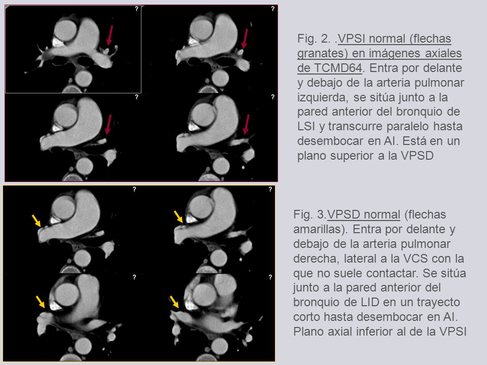 Fig. 2. VPSI normal (flechas granates) en imágenes axiales de TCMD64