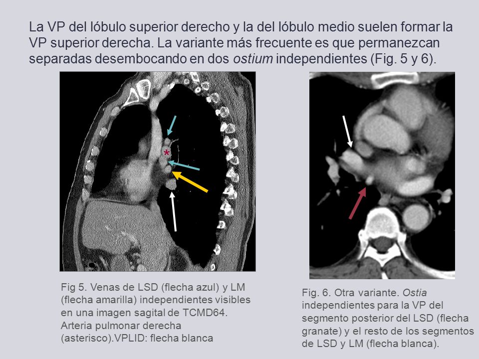 La VP del lóbulo superior derecho y la del lóbulo medio suelen formar la VP superior derecha. La variante más frecuente es que permanezcan separadas desembocando en dos ostium independientes (Fig. 5 y 6).