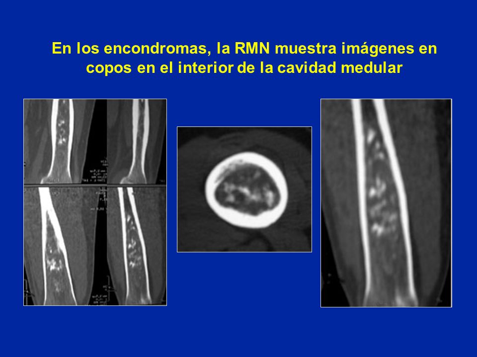 En los encondromas, la RMN muestra imágenes en copos en el interior de la cavidad medular