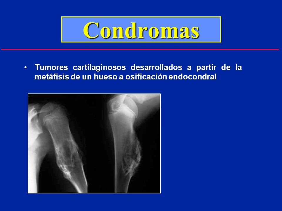 Condromas Tumores cartilaginosos desarrollados a partir de la metáfisis de un hueso a osificación endocondral.