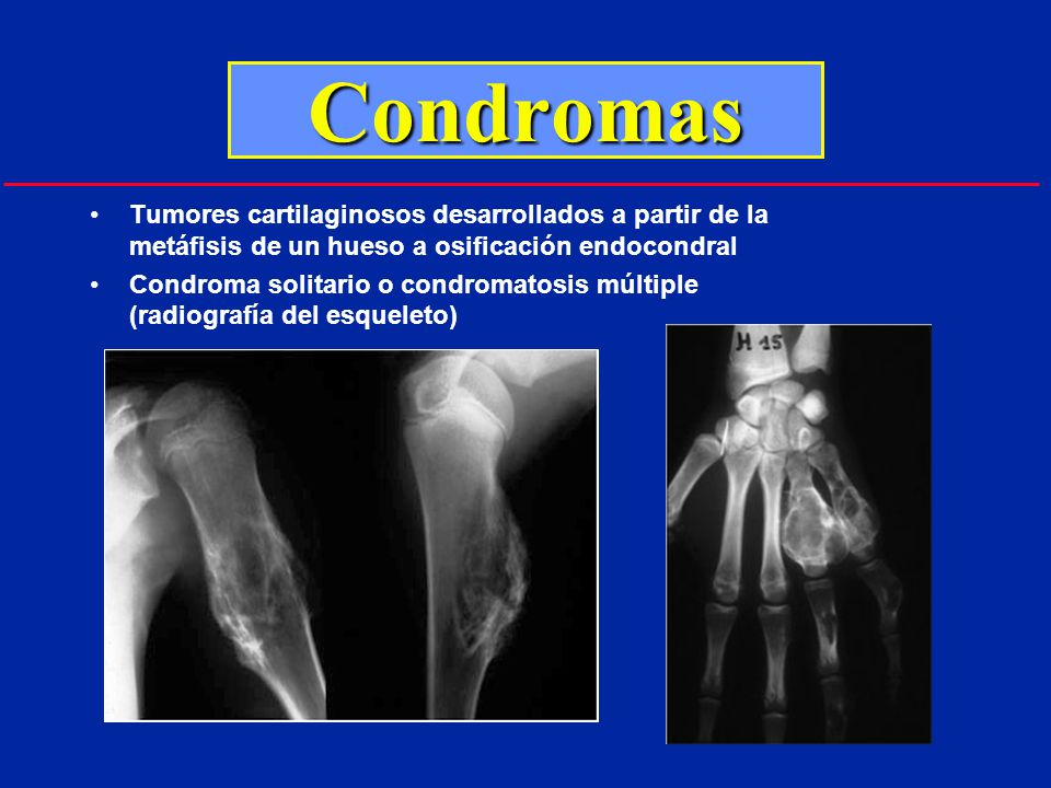 Condromas Tumores cartilaginosos desarrollados a partir de la metáfisis de un hueso a osificación endocondral.