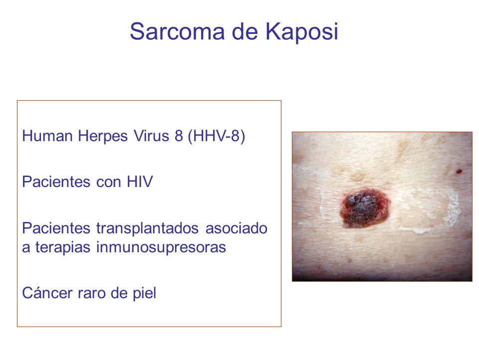 Sarcoma de Kaposi Human Herpes Virus 8 (HHV-8) Pacientes con HIV