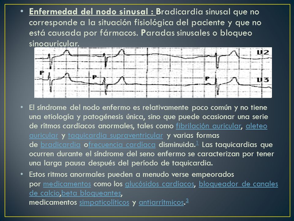 Enfermedad del nodo sinusal : Bradicardia sinusal que no corresponde a la situación fisiológica del paciente y que no está causada por fármacos. Paradas sinusales o bloqueo sinoauricular.