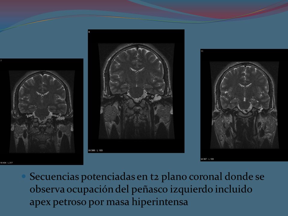 Secuencias potenciadas en t2 plano coronal donde se observa ocupación del peñasco izquierdo incluido apex petroso por masa hiperintensa