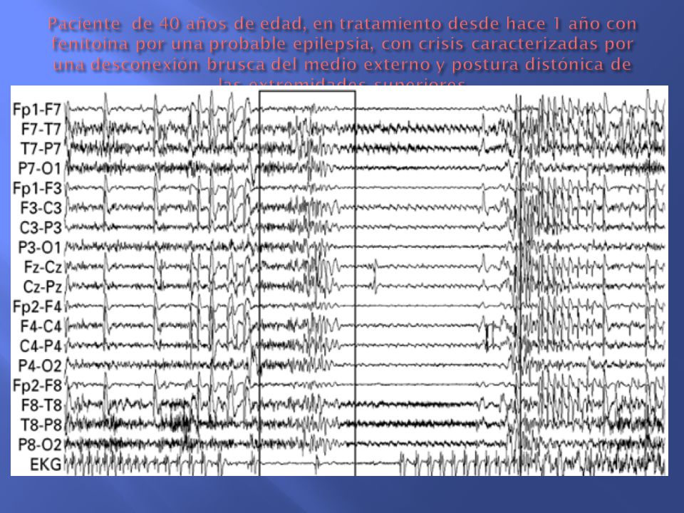 Paciente de 40 años de edad, en tratamiento desde hace 1 año con fenitoina por una probable epilepsia, con crisis caracterizadas por una desconexión brusca del medio externo y postura distónica de las extremidades superiores