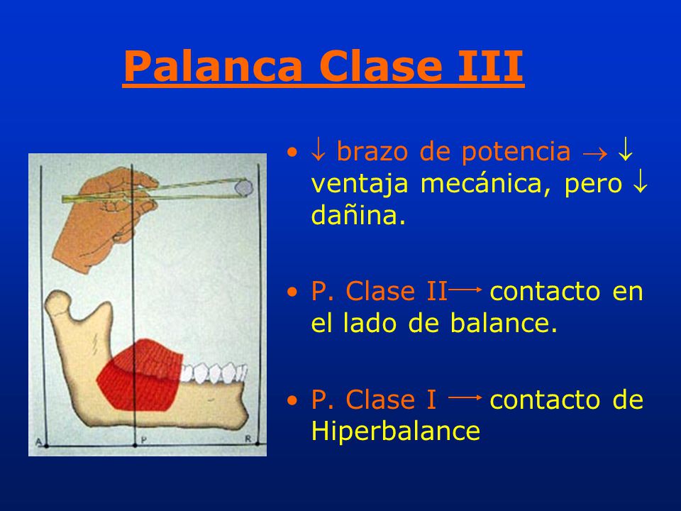 Palanca Clase III  brazo de potencia   ventaja mecánica, pero  dañina. P. Clase II contacto en el lado de balance.