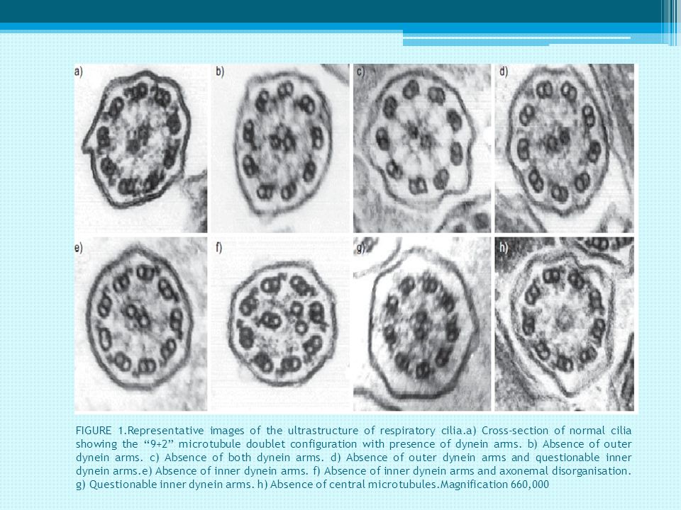 FIGURE 1.Representative images of the ultrastructure of respiratory cilia.a) Cross-section of normal cilia showing the ‘‘9+2’’ microtubule doublet configuration with presence of dynein arms.