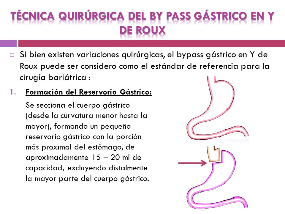 TÉCNICA QUIRÚRGICA DEL BY PASS GÁSTRICO EN Y DE ROUX