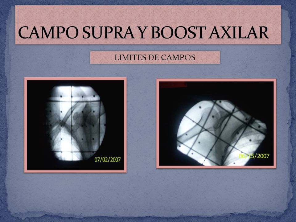 CAMPO SUPRA Y BOOST AXILAR