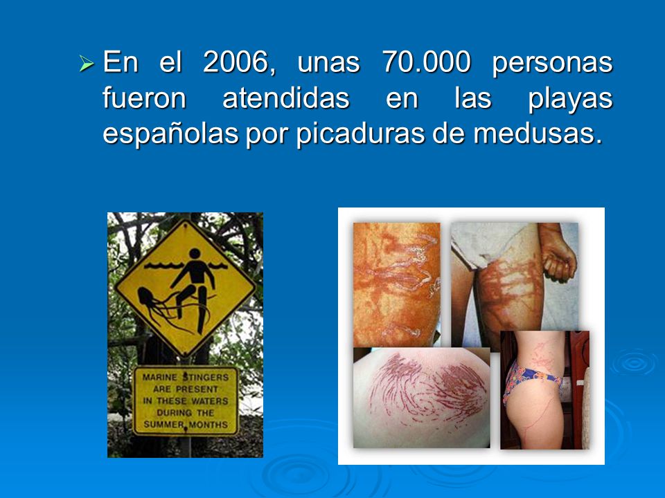 En el 2006, unas personas fueron atendidas en las playas españolas por picaduras de medusas.