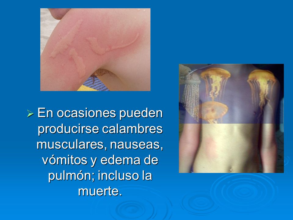 En ocasiones pueden producirse calambres musculares, nauseas, vómitos y edema de pulmón; incluso la muerte.