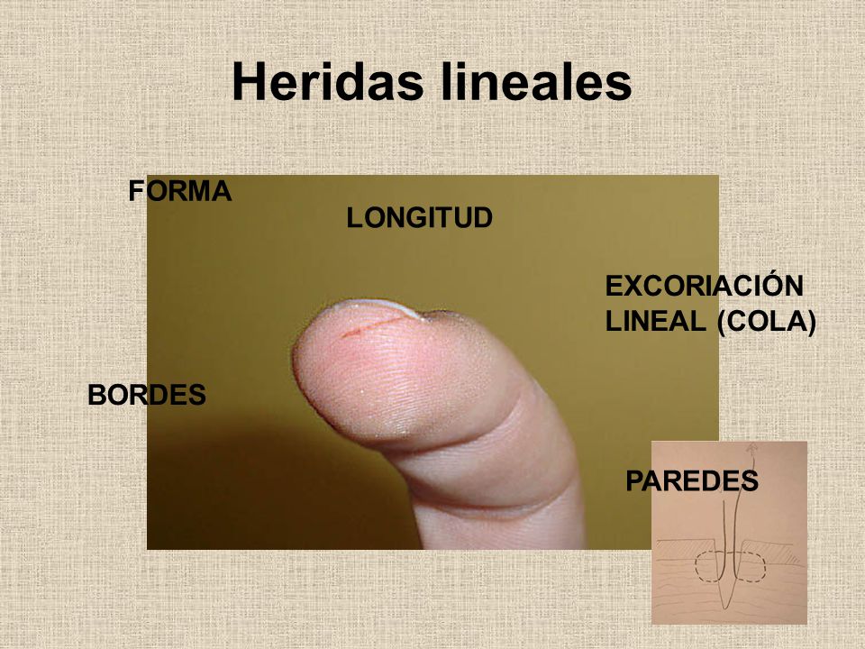 Heridas lineales FORMA LONGITUD EXCORIACIÓN LINEAL (COLA) BORDES