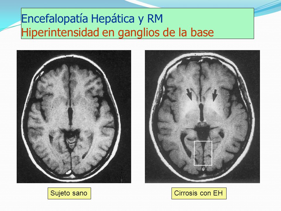 Encefalopatía Hepática y RM Hiperintensidad en ganglios de la base