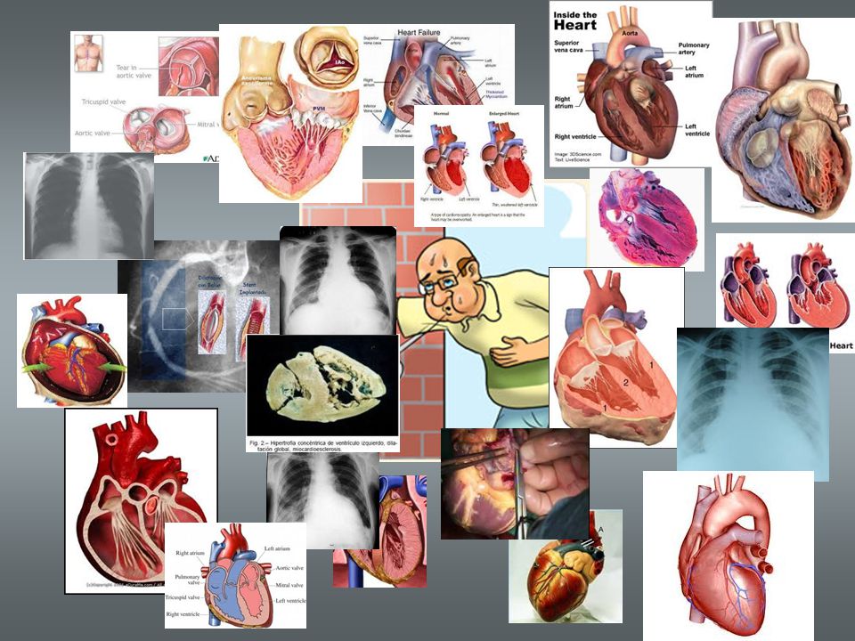 La insuficiencia cardiaca es un síndrome caracterizado por un conjunto de sintomas y signos originados por el fallo del corazón en su función de bomba y ppor ls mecanismo compensadores puestos en marcha para mantener la perfusión de los tejidos.