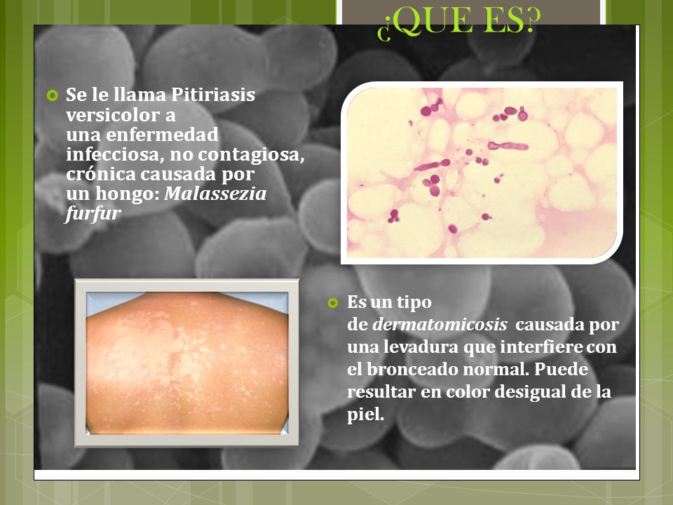 ¿QUE ES Se le llama Pitiriasis versicolor a una enfermedad infecciosa, no contagiosa, crónica causada por un hongo: Malassezia furfur.