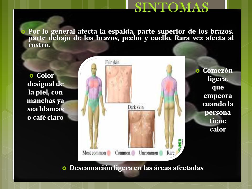 SINTOMAS Por lo general afecta la espalda, parte superior de los brazos, parte debajo de los brazos, pecho y cuello. Rara vez afecta al rostro.