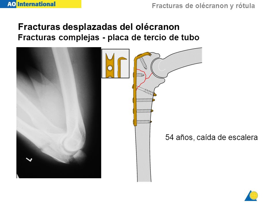 Fracturas desplazadas del olécranon Fracturas complejas - placa de tercio de tubo
