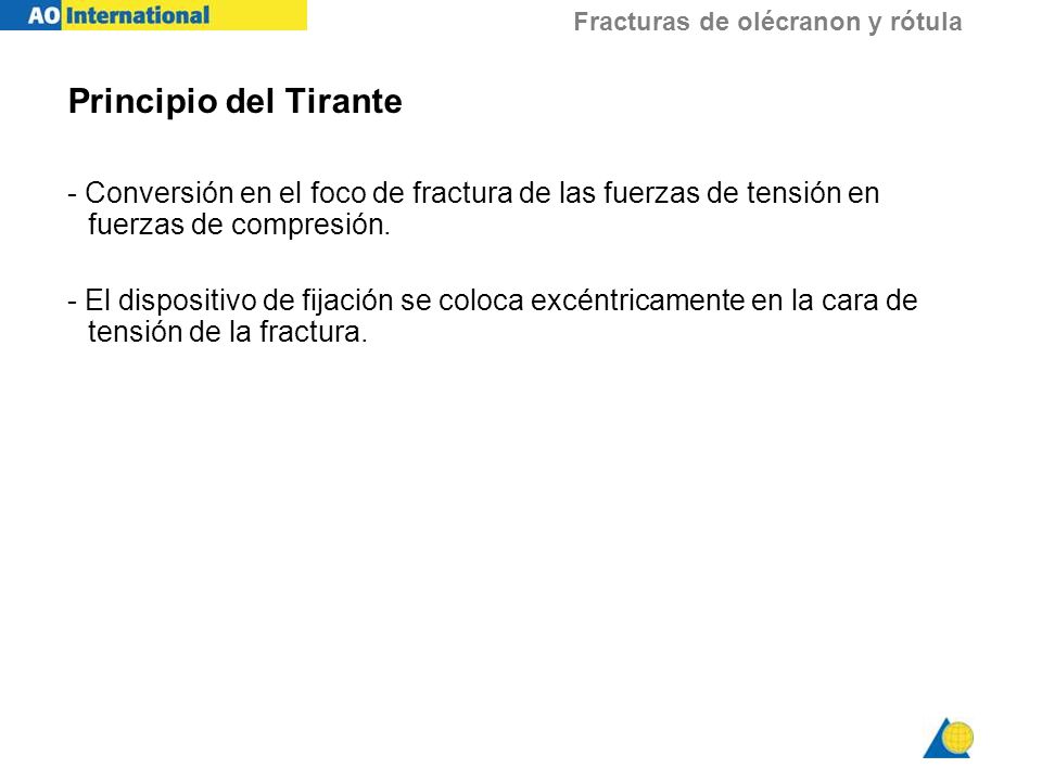 Principio del Tirante - Conversión en el foco de fractura de las fuerzas de tensión en fuerzas de compresión.