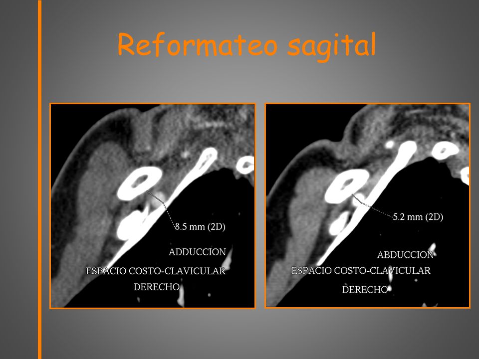 Reformateo sagital