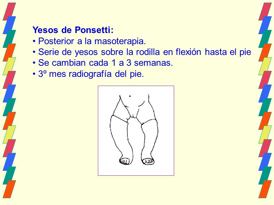 Yesos de Ponsetti: Posterior a la masoterapia. Serie de yesos sobre la rodilla en flexión hasta el pie.