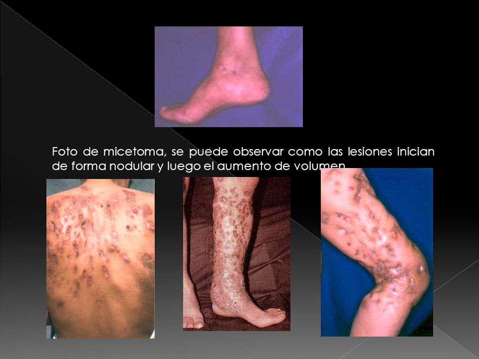 Foto de micetoma, se puede observar como las lesiones inician de forma nodular y luego el aumento de volumen.
