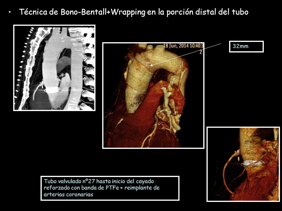 Técnica de Bono-Bentall+Wrapping en la porción distal del tubo