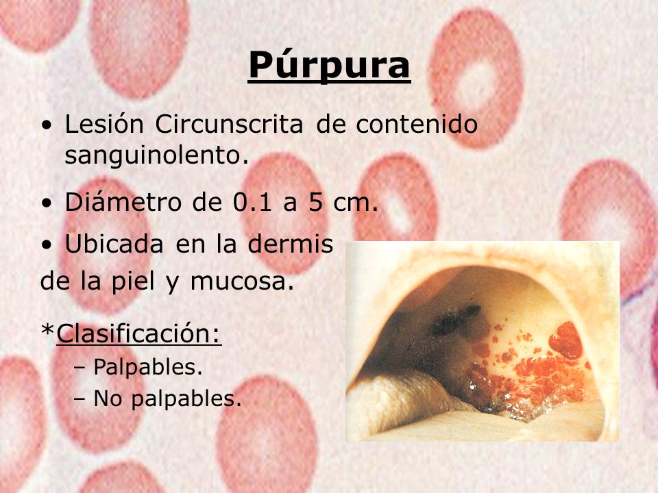 Púrpura Lesión Circunscrita de contenido sanguinolento.
