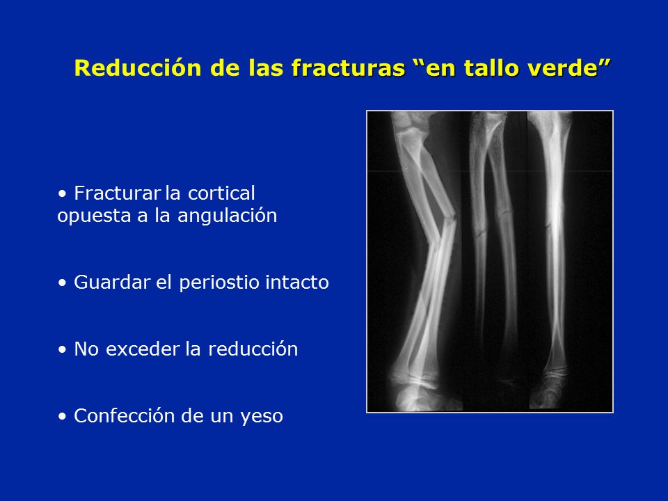 Reducción de las fracturas en tallo verde