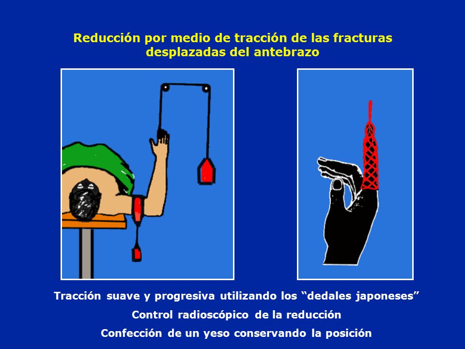 Reducción por medio de tracción de las fracturas desplazadas del antebrazo