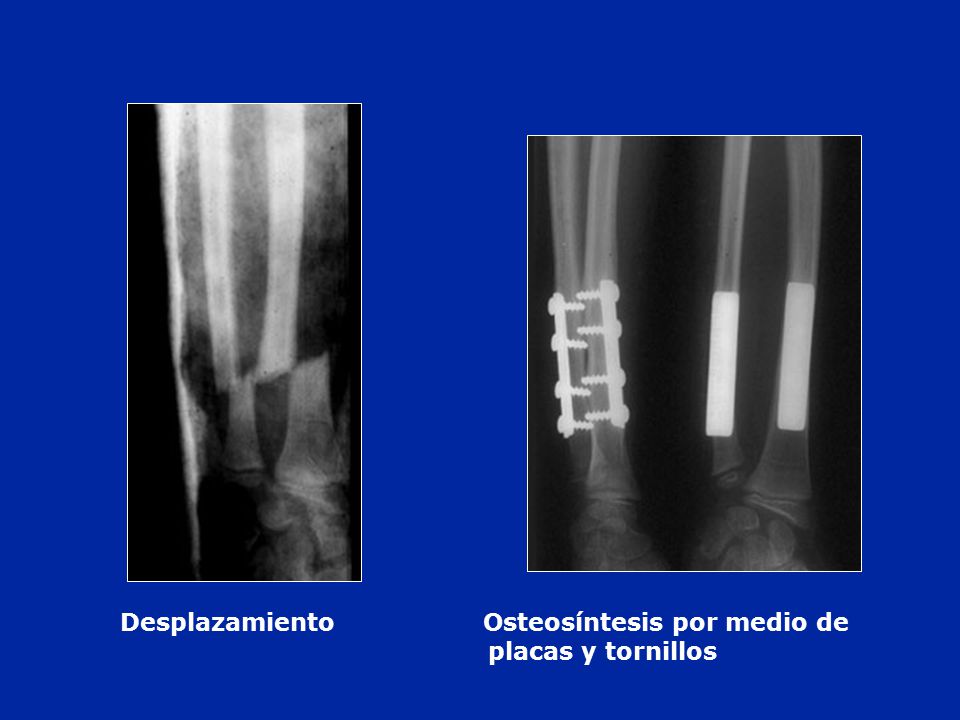 Desplazamiento Osteosíntesis por medio de placas y tornillos