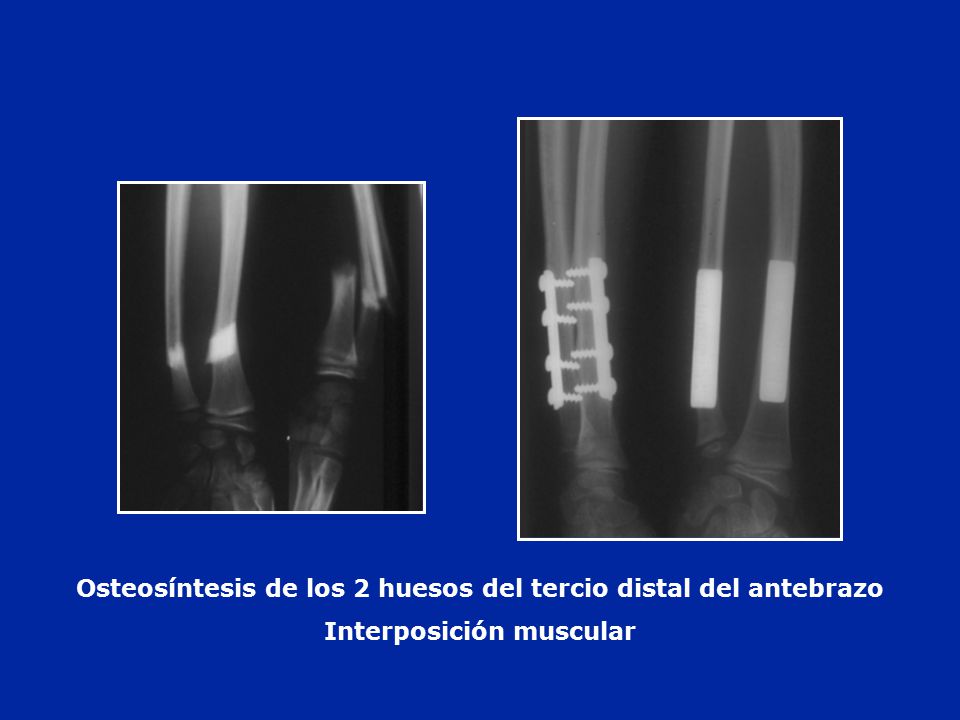Osteosíntesis de los 2 huesos del tercio distal del antebrazo