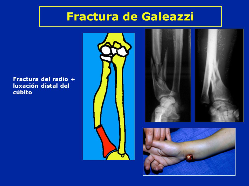 Fractura de Galeazzi Fractura del radio + luxación distal del cúbito