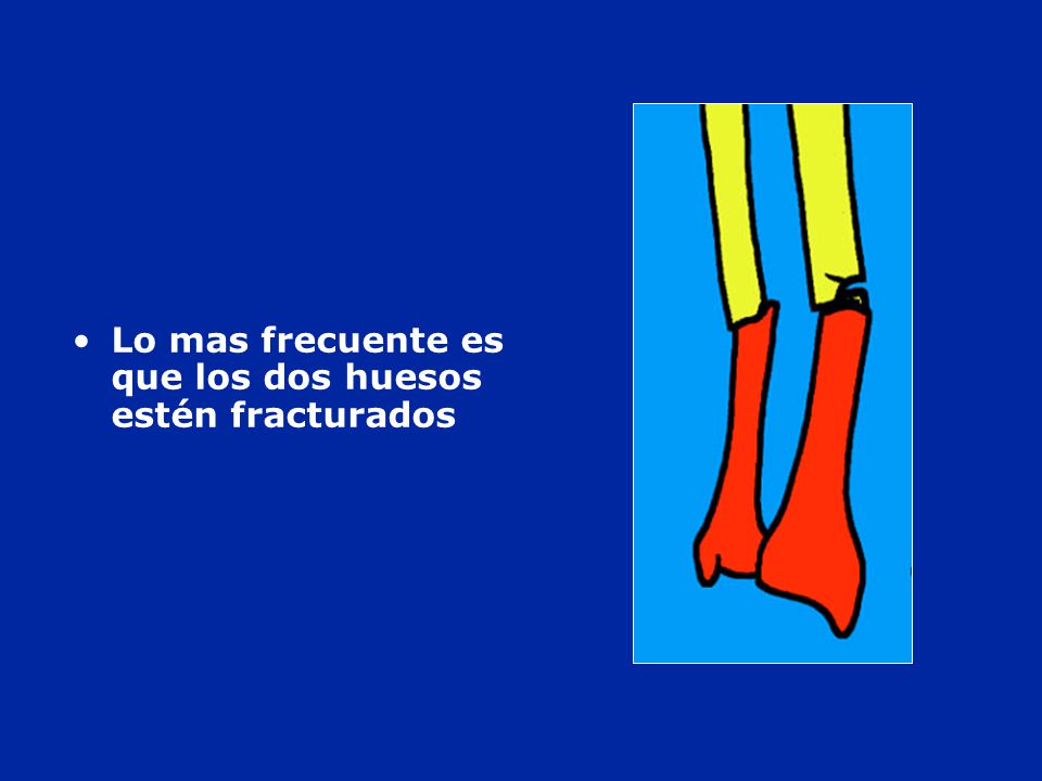 Lo mas frecuente es que los dos huesos estén fracturados