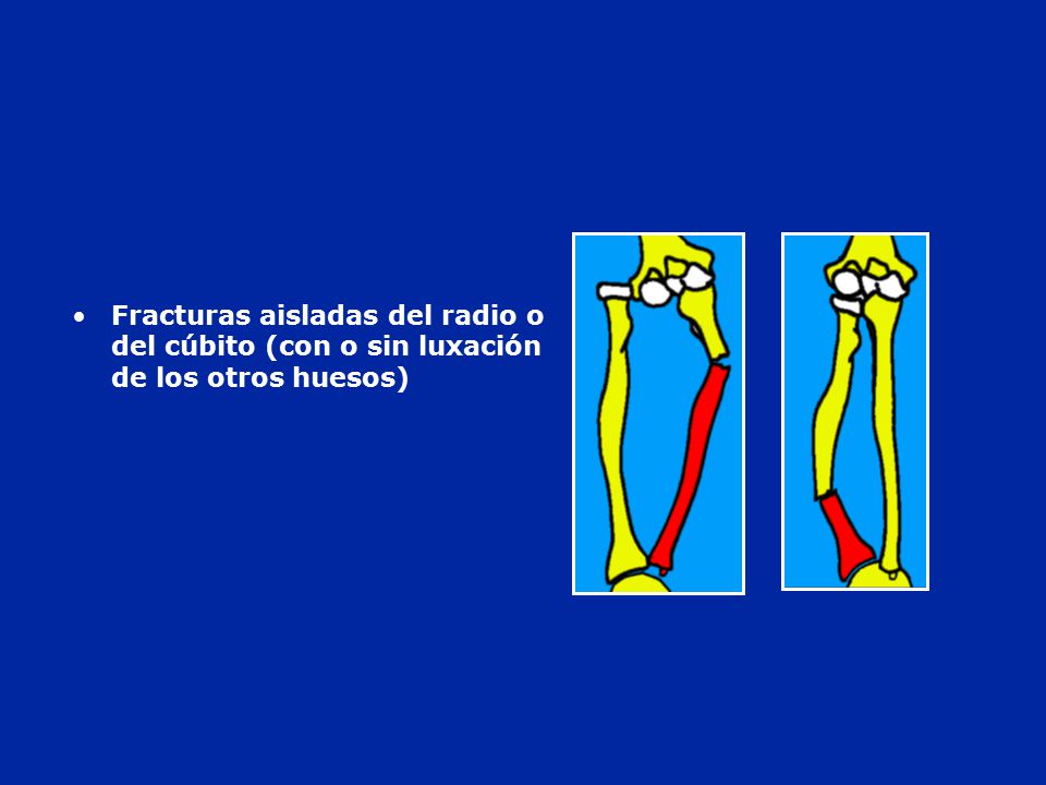 Fracturas aisladas del radio o del cúbito (con o sin luxación de los otros huesos)