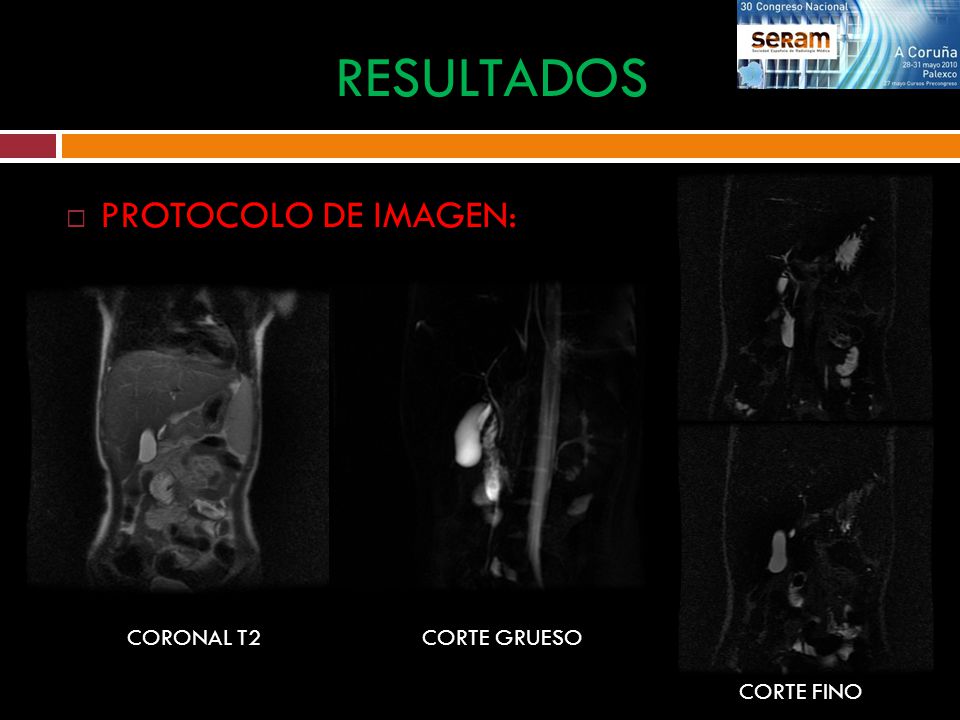 RESULTADOS PROTOCOLO DE IMAGEN: CORONAL T2 CORTE GRUESO CORTE FINO