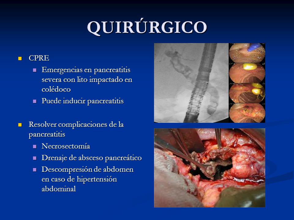 QUIRÚRGICO CPRE. Emergencias en pancreatitis severa con lito impactado en colédoco. Puede inducir pancreatitis.