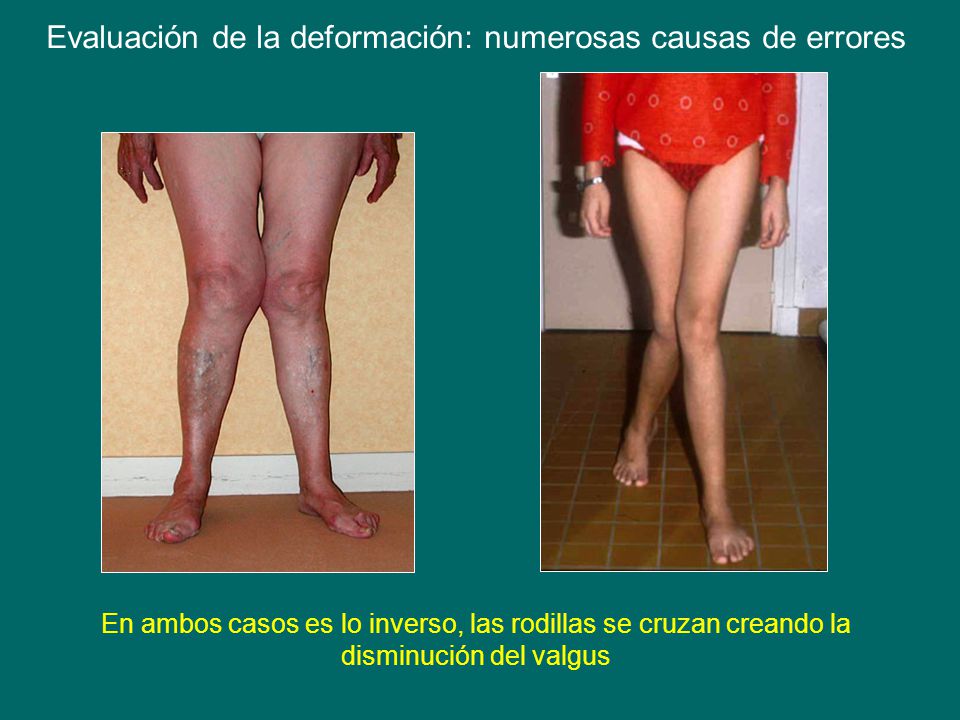 Evaluación de la deformación: numerosas causas de errores