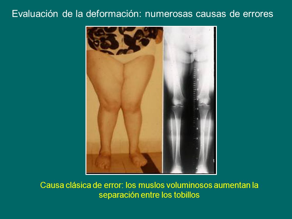 Evaluación de la deformación: numerosas causas de errores