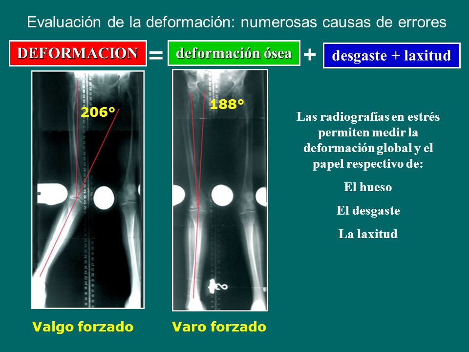 Evaluación de la deformación: numerosas causas de errores