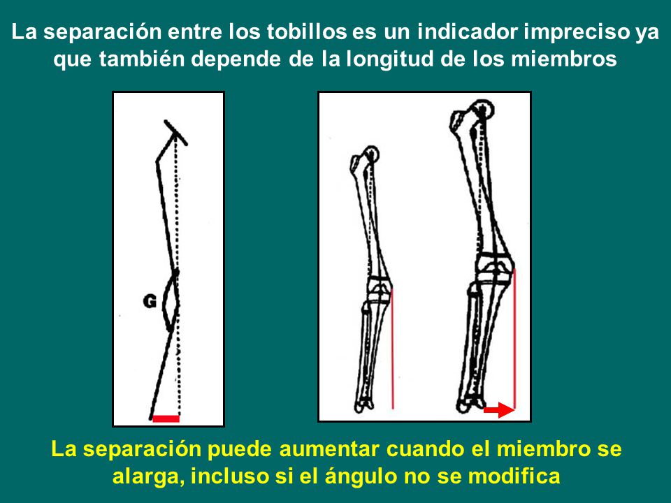 La separación entre los tobillos es un indicador impreciso ya que también depende de la longitud de los miembros